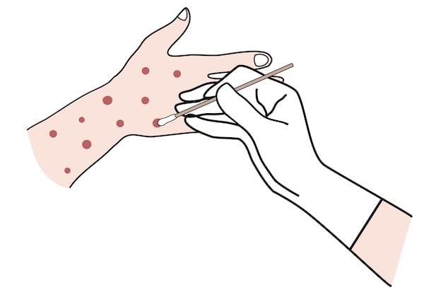 A hand with mpox spots on the skin is being swabbed with a cotton swab by another hand.