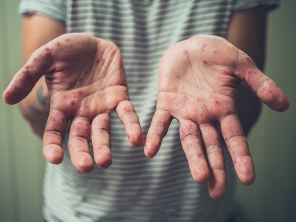 A person is holding out both hands, which are covered with red spots or rashes, indicating a skin condition. The background is blurred, with the person wearing a striped shirt.