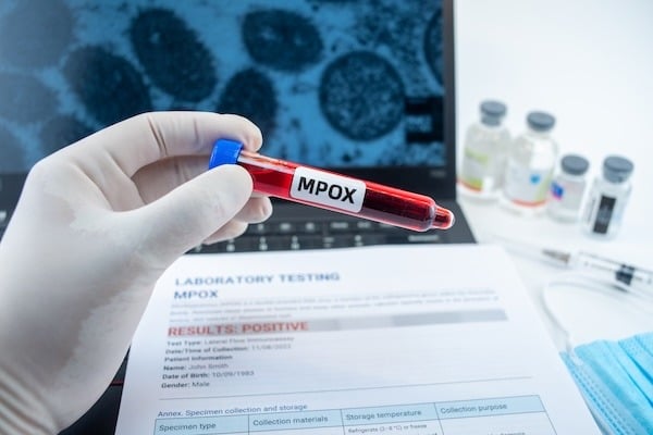 A gloved hand holds a test tube labeled 'MPOX' above a laboratory testing report that reads 'RESULTS: POSITIVE.' The background includes a blurred image of cells on a laptop screen, lab vials, a syringe, and a blue medical mask. The scene represents laboratory testing for monkeypox (Mpox) infection.